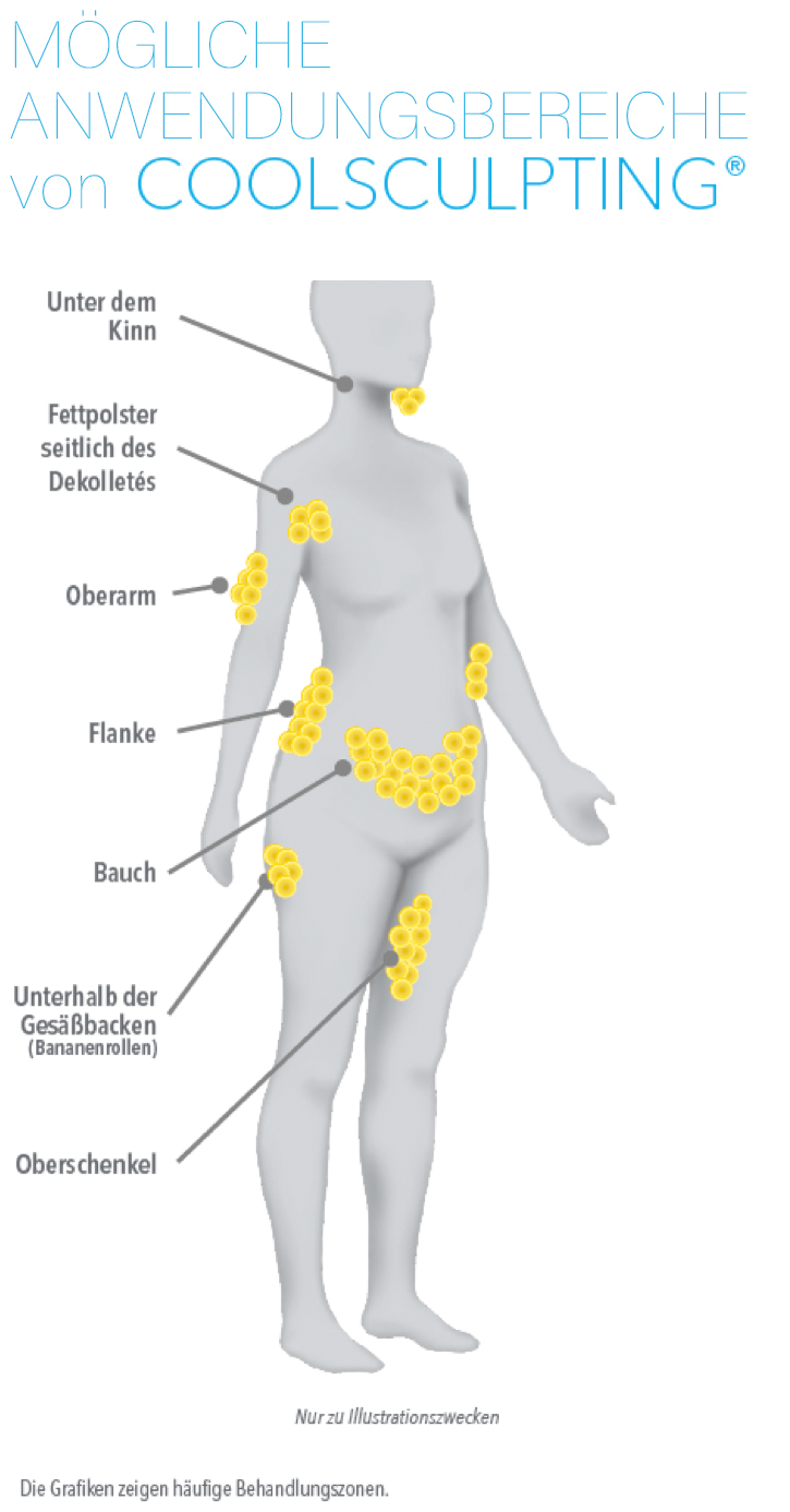 CoolSculpting Behandlungszonen