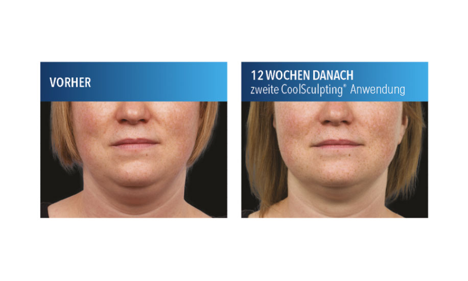 CoolSculpting® am Doppelkinn
