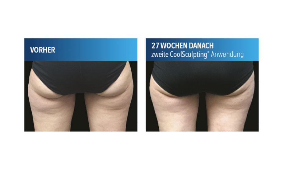 CoolSculpting® unterhalb des Gesäßes (Bananenrolle)