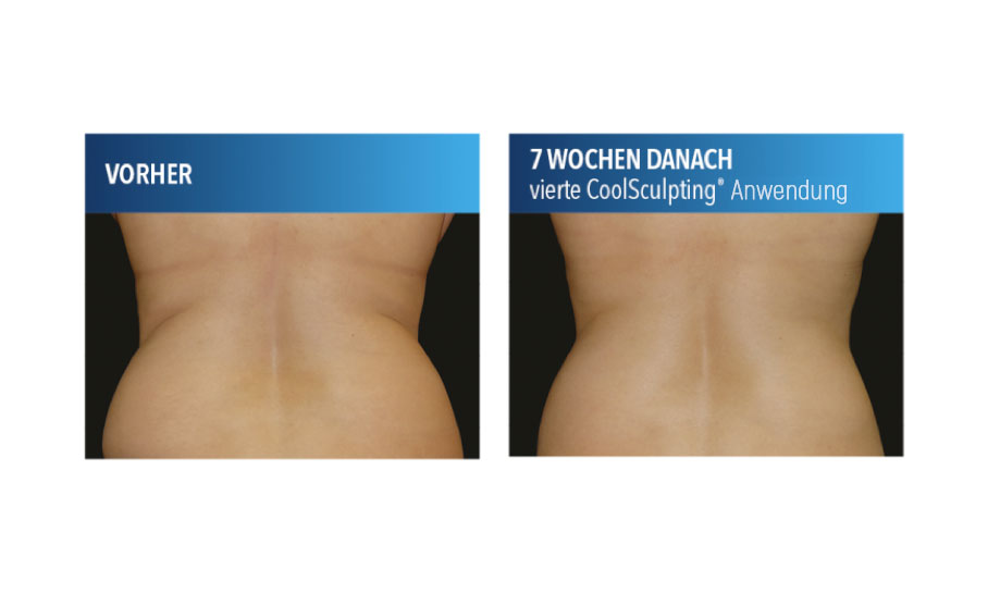 CoolSculpting®-Anwendung an der Hüfte
