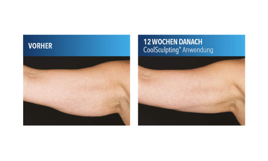 CoolSculpting®-Anwendung am Oberarm
