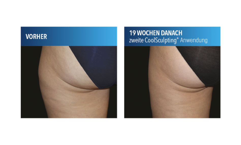 CoolSculpting®-Anwendung am Gesäß